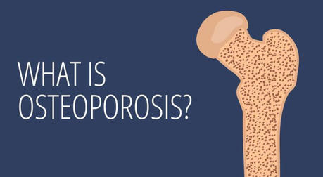 Osteoporosis Explained: Protecting Your Bones as You Age